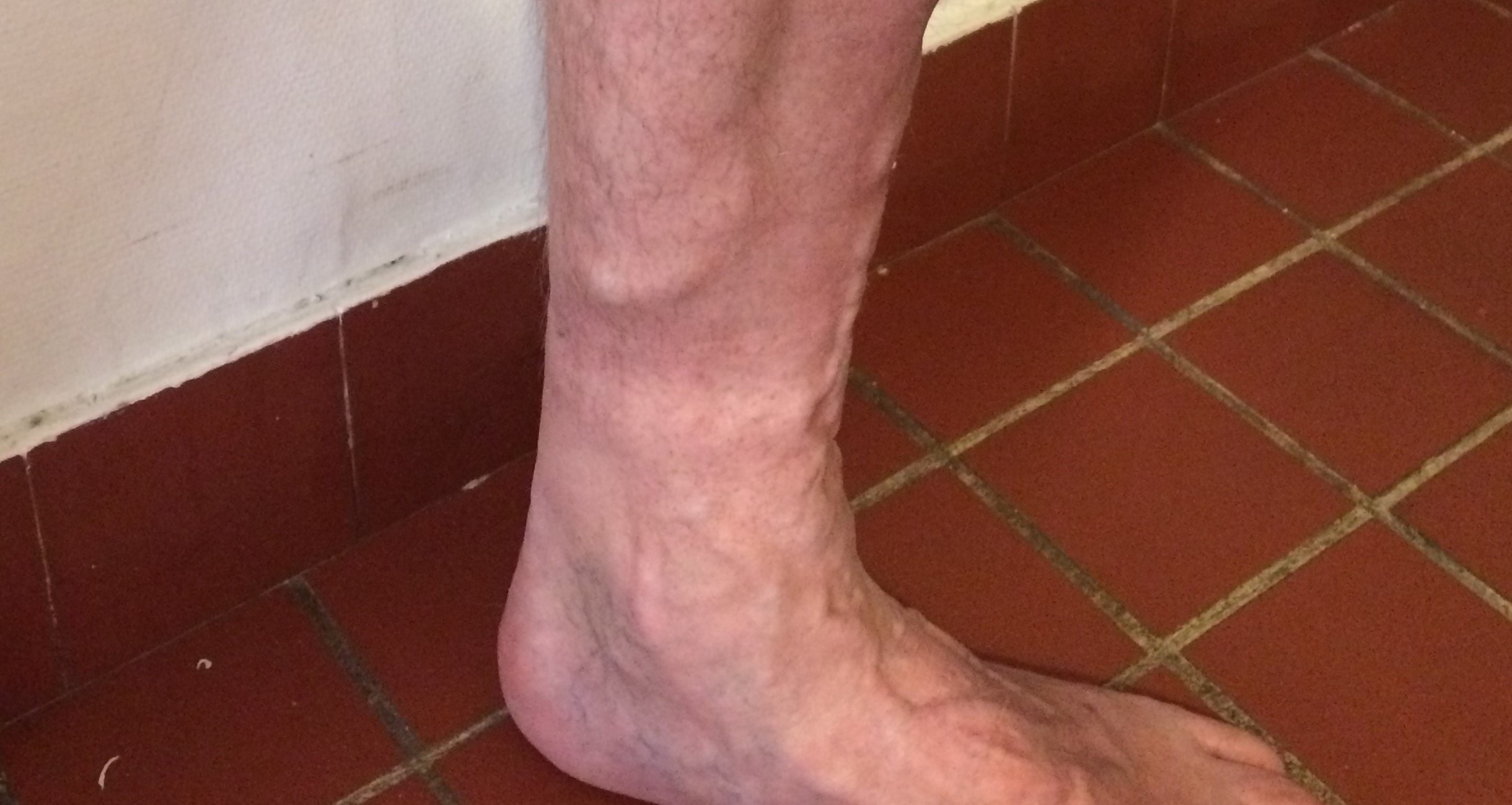 CMVC Varices, symptômes de la maladie veineuse chronique